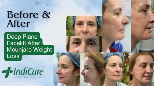 Before after results of deep plane facelift after mounjaro weight loss